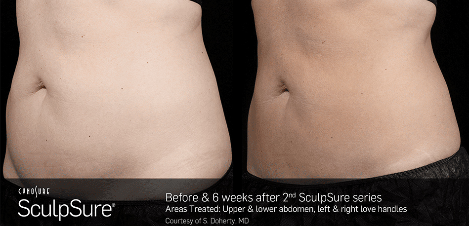 Irvine Family Care - SculpSure - Before and After Photos