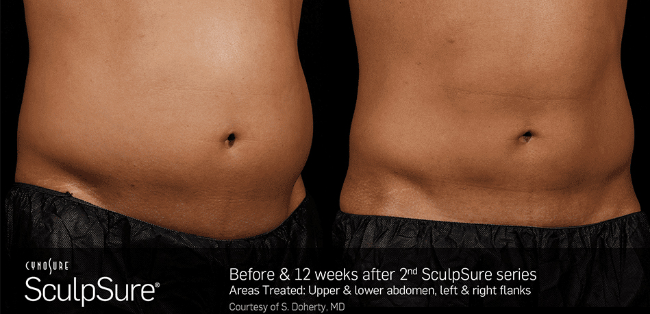 Irvine Family Care - SculpSure - Before and After Photos